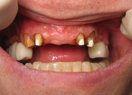 Typical Example of Heavily Prepped Teeth that weaken and may kill the Nerves in Teeth too! Typical Example of Heavily Prepped Teeth that weaken and may kill the Nerves in Teeth too!